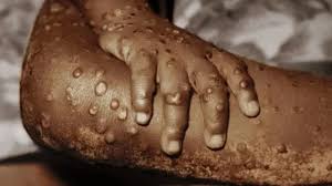 Mpox outbreak will rise next year, Africa CDC warns